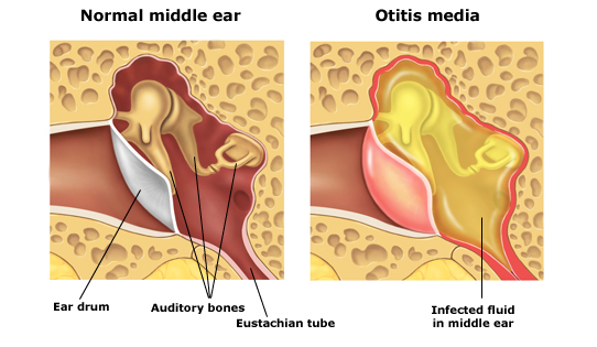 Rinitis No Alérgica - infecciones del oido