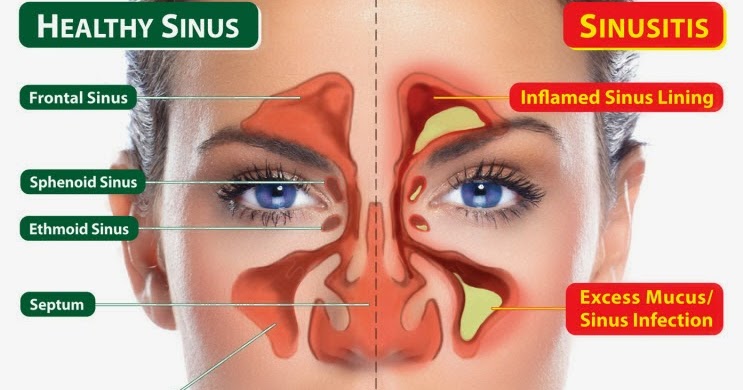 Rinitis No Alérgica - Sinusitis